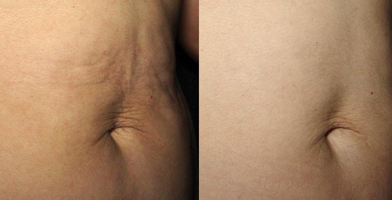 Titan Skin Firming Laser Results