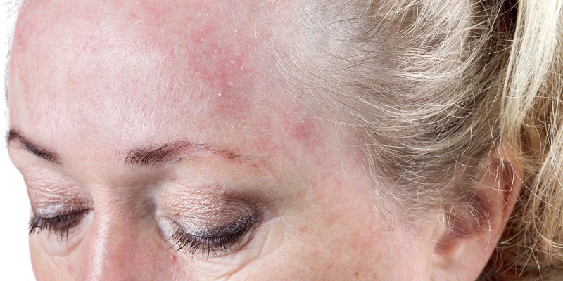 rosacea bumps or acne