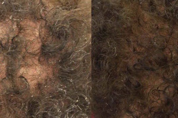 prp hair restoration