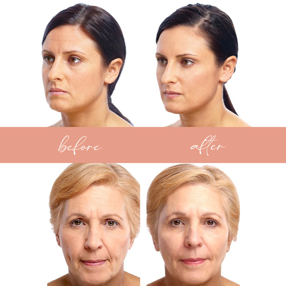 instant facelift results